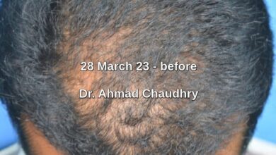 Exosome hair therapy for hair regeneration and growth Pakistan Exosome hair therapy for hair regeneration and growth Pakistan