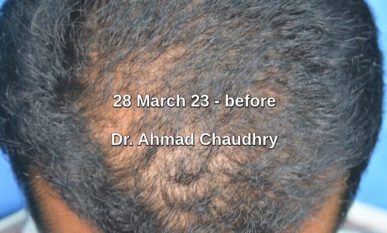 Exosome hair therapy for hair regeneration and growth Pakistan Exosome hair therapy for hair regeneration and growth Pakistan